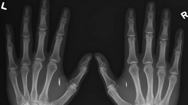 implantados pueden detectados traves radiografia CLAIMA20151102 0010 28 - ¿CAMINO A LA MARCA DE LA BESTIA? MÁS DE 10 MIL PERSONAS YA SE IMPLANTARON EL CHIP CON LA TECNOLOGÍA "NFC"